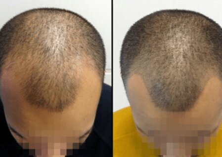 Scalp Micropigmentation