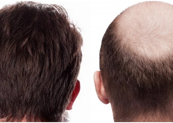 Hair Transplantation