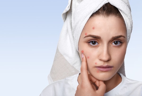 Pimple treatment